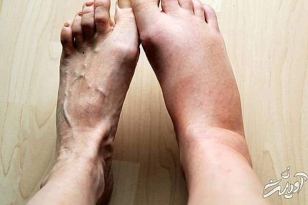 تورم ساق پا از نشانه های سکته قلبی تورم ساق پا